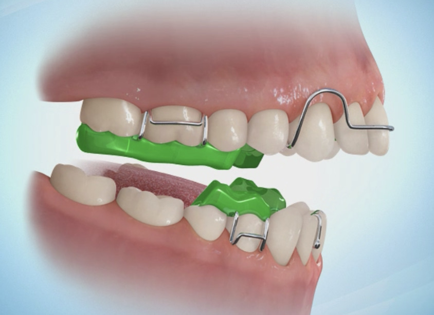 Ορθοδοντική για Παιδιά